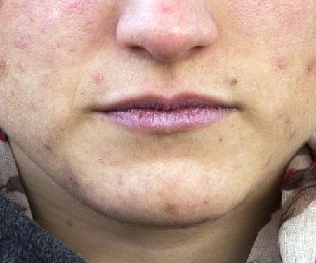 El acne puede dejar máculas en la piel