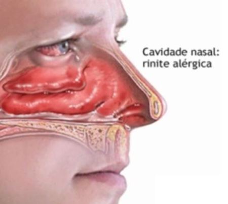 inflamacion de las fosas nasales